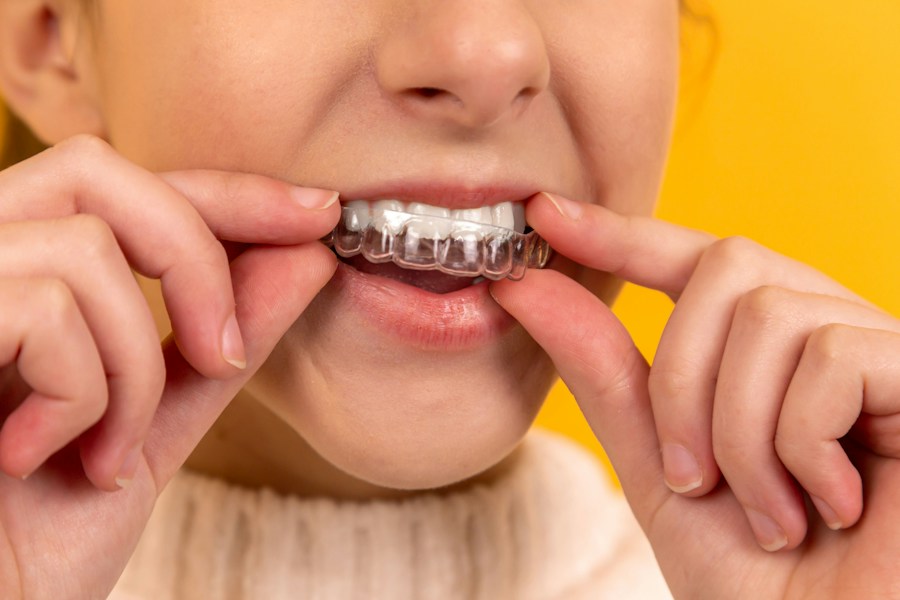 Persona mostrando un alineador dental transparente